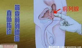 前列腺在哪位置图，手指伸入肛门2cm能摸到(附保养方法)